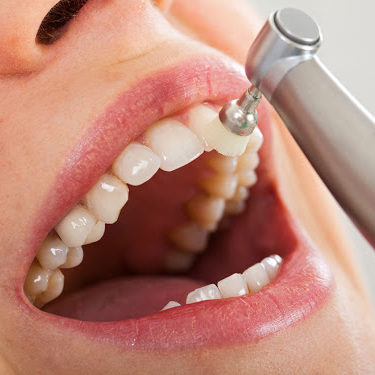 scaling and polishing